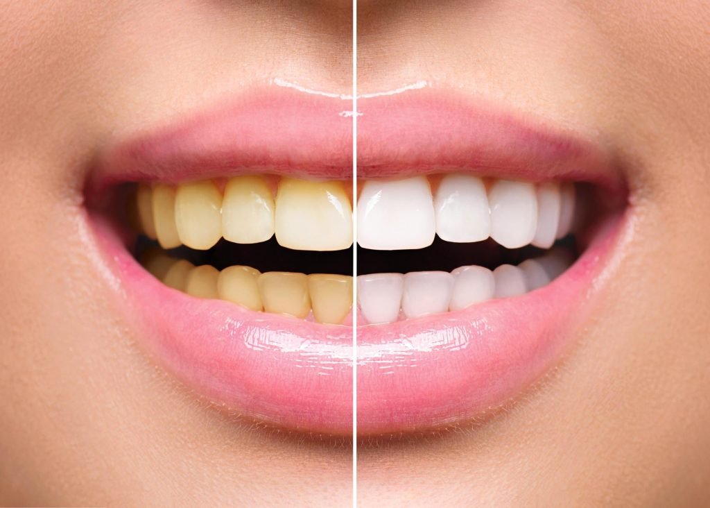 Blanqueamiento dental