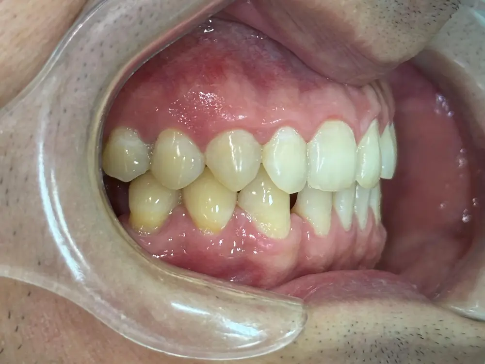 Vista lateral derecha de un caso clínico dental