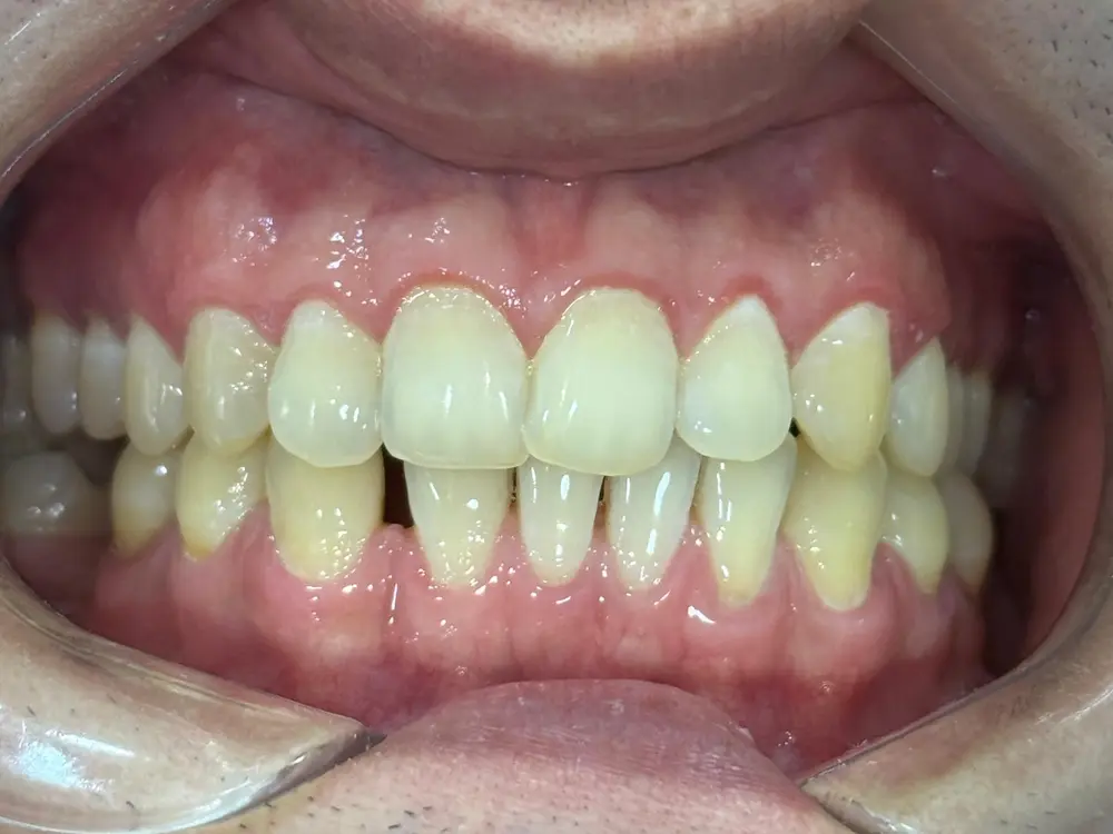 Vista frontal de un caso clínico de alineación dental