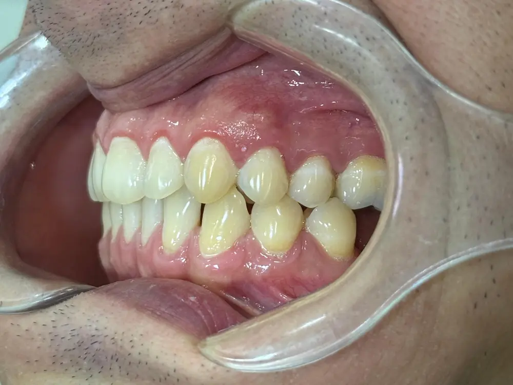 Vista lateral izquierda de un caso clínico dental