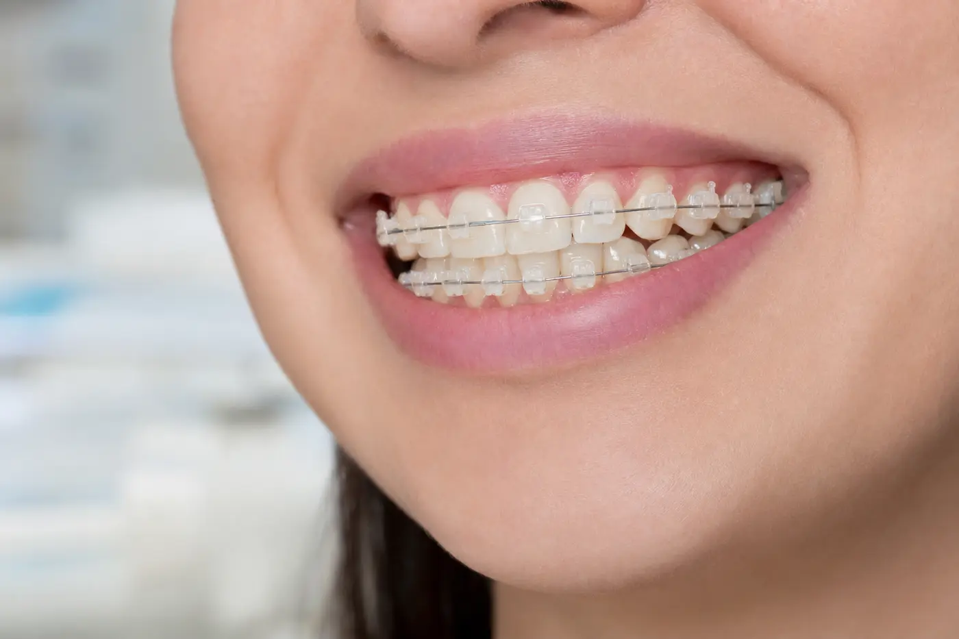 Sonrisa con brackets cerámicos