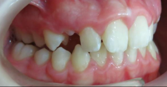 Vista lateral derecha de dientes con apiñamiento