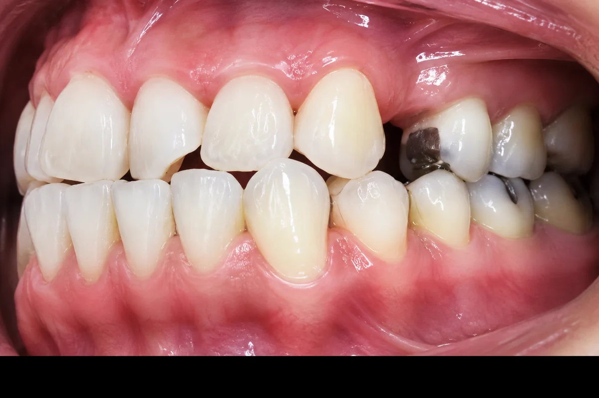 Fotografía clínica de espacios entre dientes
