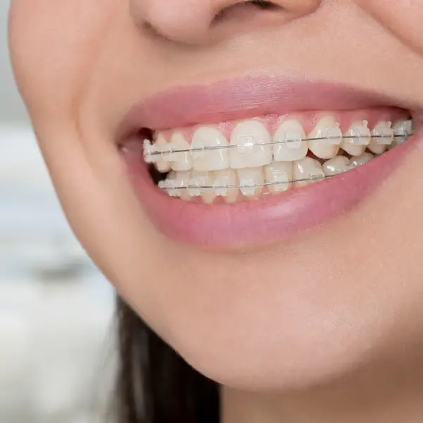 Etapa de planificación personalizada con brackets cerámicos