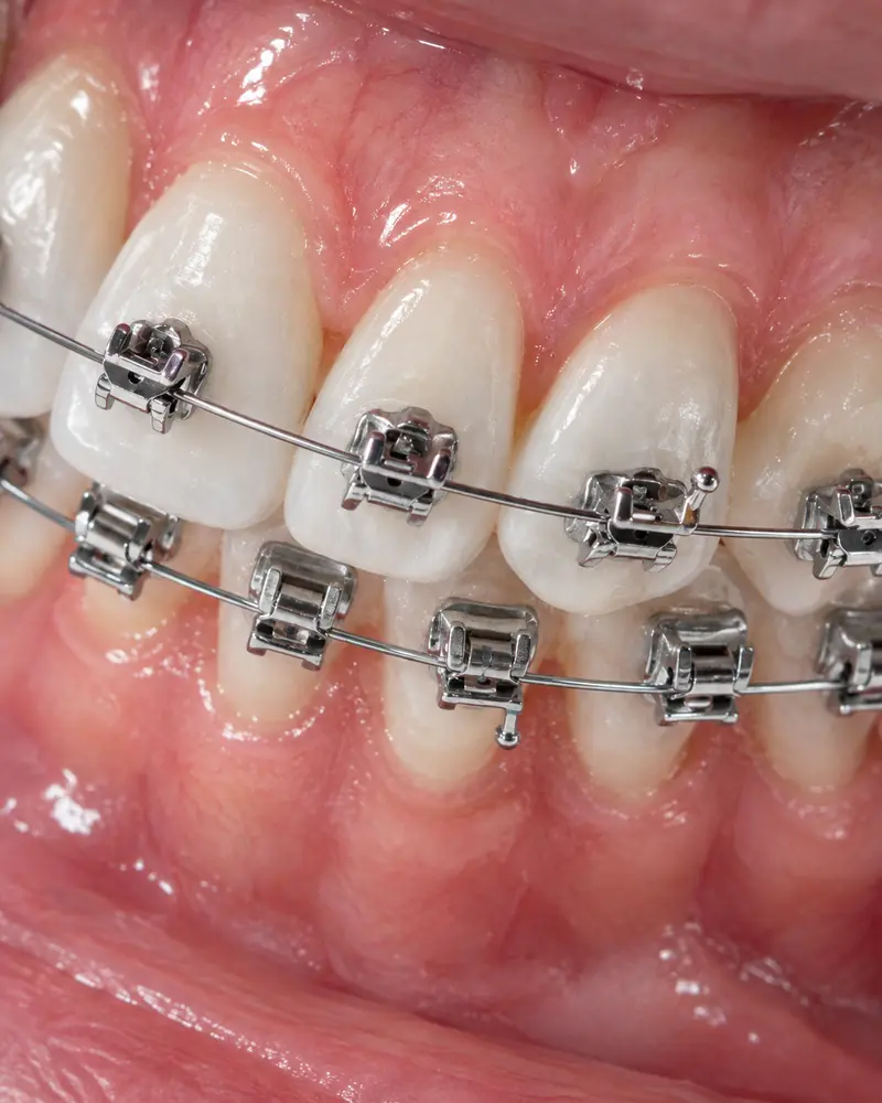 Tratamiento de ortodoncia en IODOF